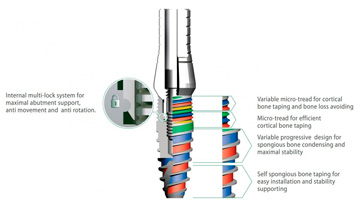 Имплантат «Перфект»