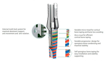Имплантат «Прима»