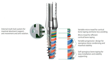Имплантат «Юник»